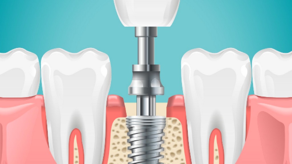 Dental İmplant Ürünleri