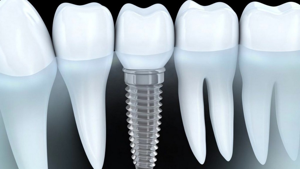 Dental İmplantlar