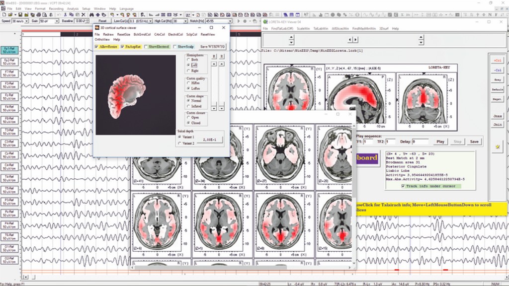 Eeg Analiz Yazılımı