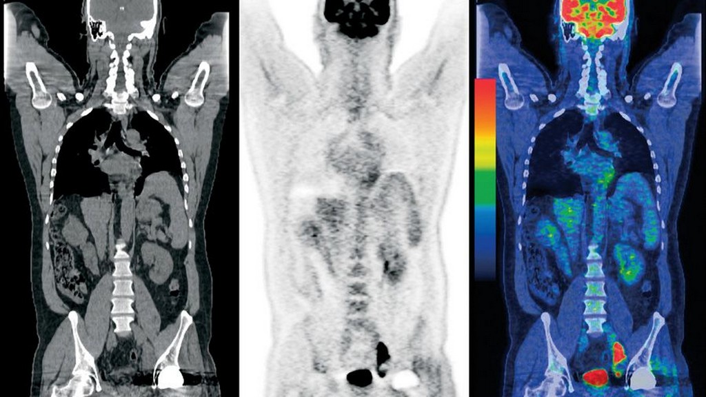 Pet/Ct Kombinasyonlu Tarayıcılar