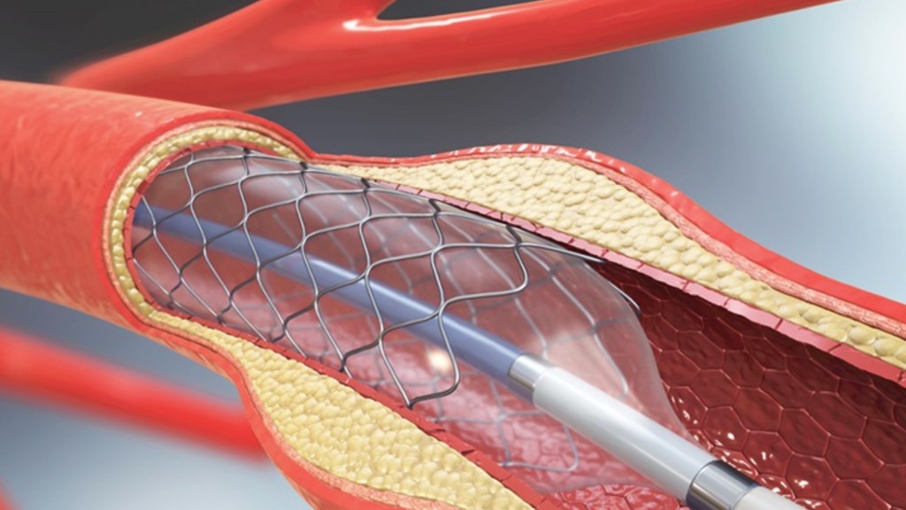Renal Arter Stentleri