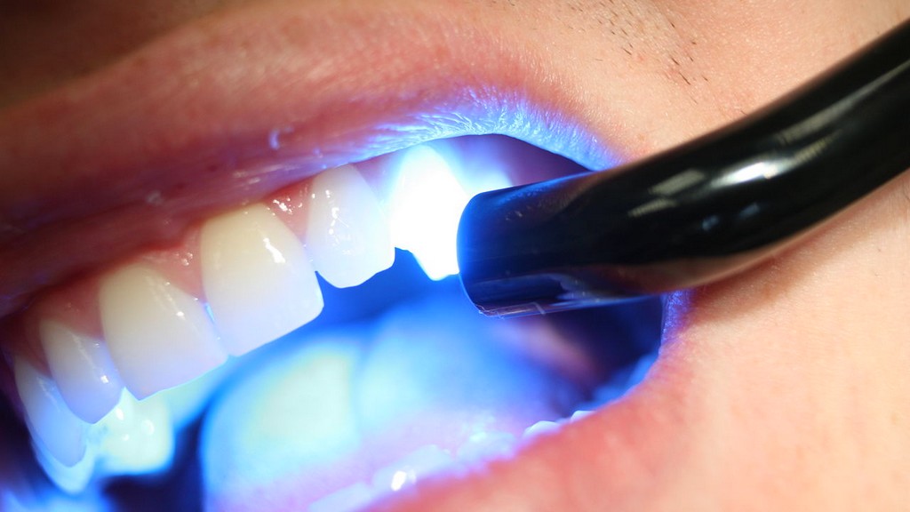 Uv Polimerizasyon Lambası